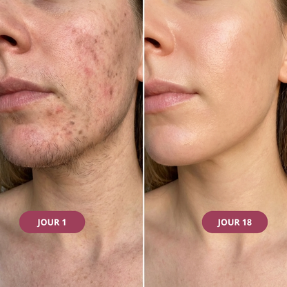 Kit Anti-Repousse Melysor