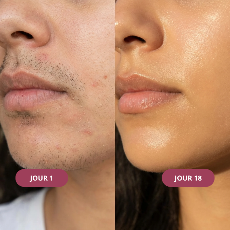 Kit Anti-Repousse Melysor