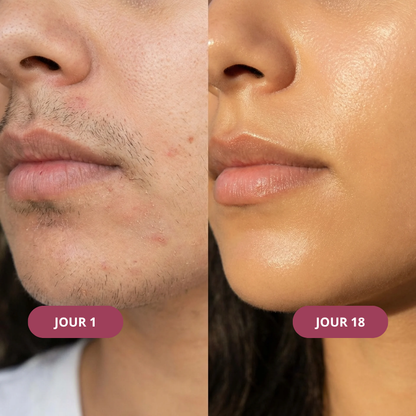 Kit Anti-Repousse Melysor