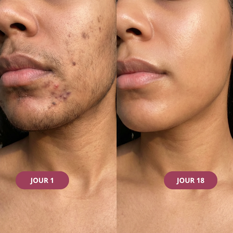 Kit Anti-Repousse Melysor